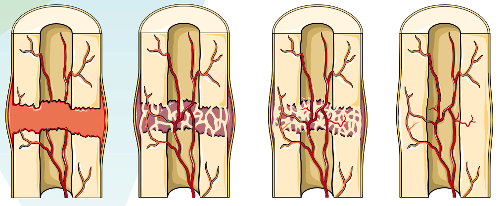 Quatre morceaux d'os sont représentés sur ce schéma, le premier est fracturé au milieu, les vaisseaux sanguins se peuvent plus passer d'un bout à l'autre. Les trois autres morceaux d'os montrent comment la fracture va se réparer, on voit le tissu osseux qui se régénère ainsi que les vaisseaux sanguins.