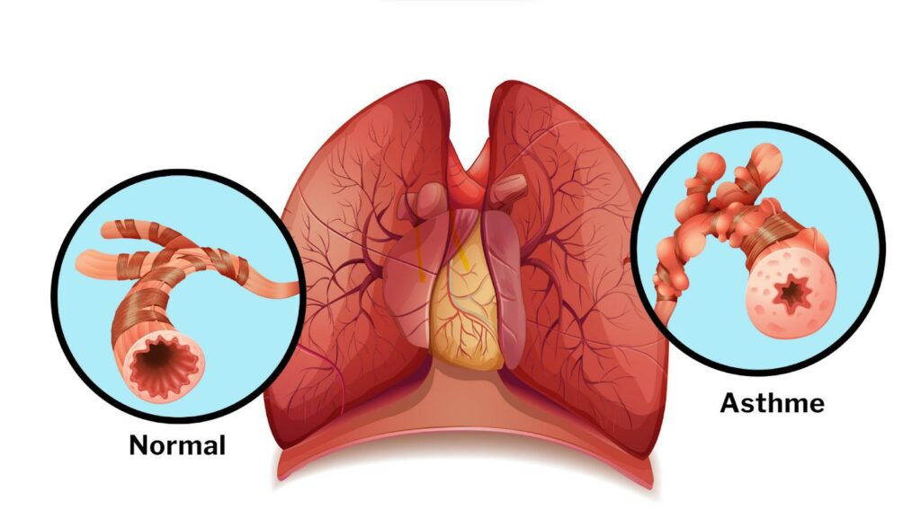 Schéma Poumon Asthme