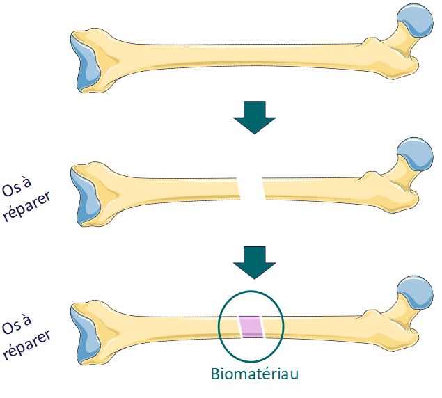 Schéma qui montre un os à réparer car il a été fracturé. On voit tout d'abord l'os intact, puis en dessous l'os fracturé en deux et en troisième la fracture dans l'os à été comblée avec le biomateriau pour aider l'os à se réparer.