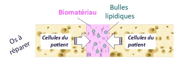 Schéma qui montre un os coupé en deux dans la longueur. Cet os est à réparer car il a été fracturé. On voit les cellules qui circulent à l'intérieur et au milieu, en rose, est schématisé le biomatériau qui vient combler la fracture. Dans le biomateriau sont représentées des bulles lipidiques par des ronds bleus.